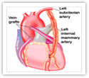 Coronary Artery Disease