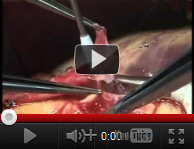 Heart Surgery Videos